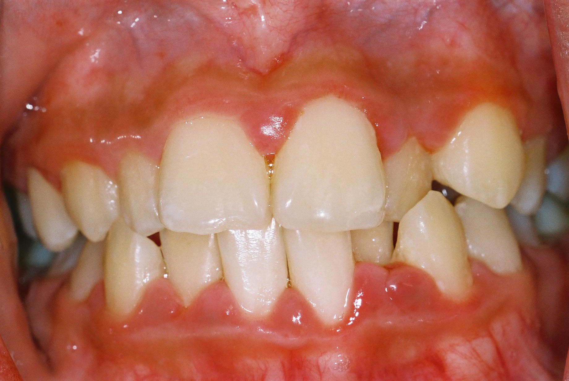 White spots and sores on gums: Causes, treatment, and symptoms